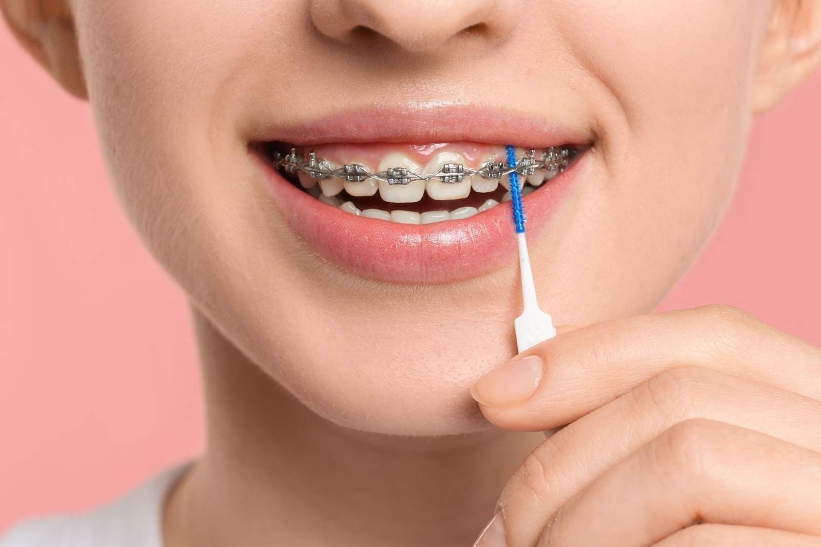 Braces Cleaning Tips That Help Teeth Stay Healthy