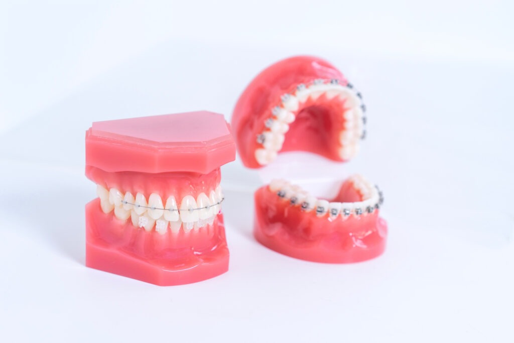 Orthodontic patient smiling after treatment at Adirondack Orthodontics
