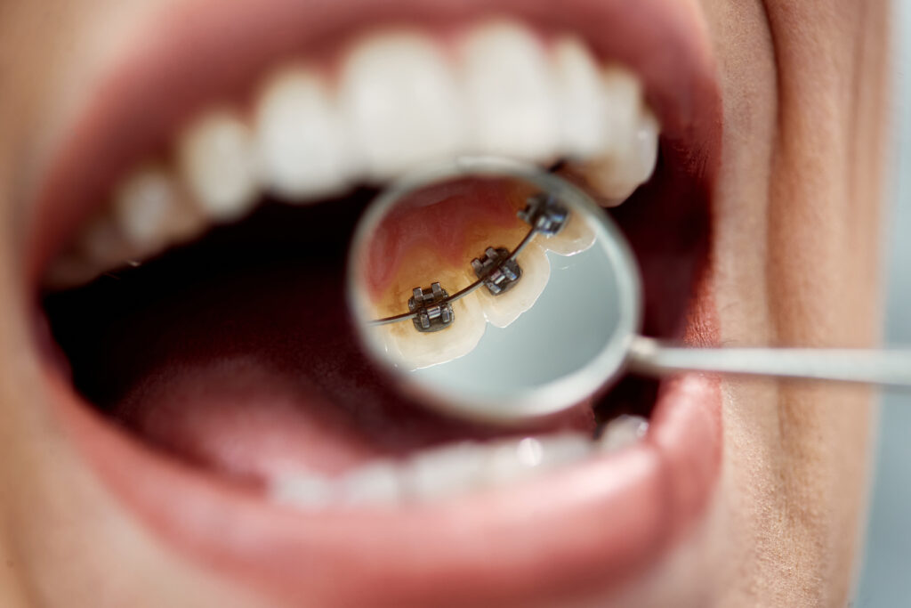 Orthodontist checking lingual braces in Albany, NY